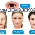 Когда в коже поселились клещи: понятный план борьбы с демодекозом