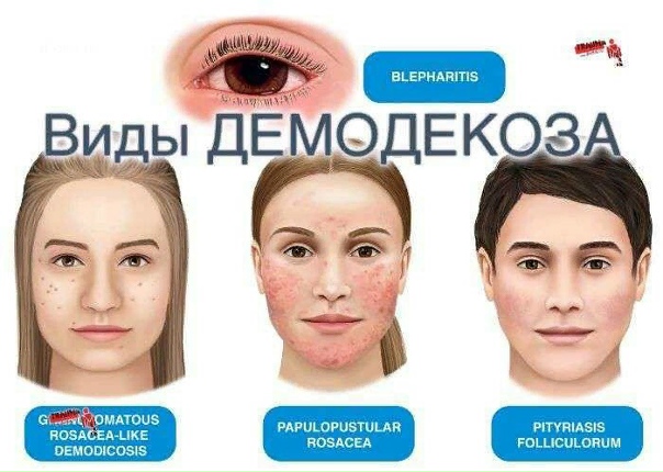 Когда в коже поселились клещи: понятный план борьбы с демодекозом онлайн